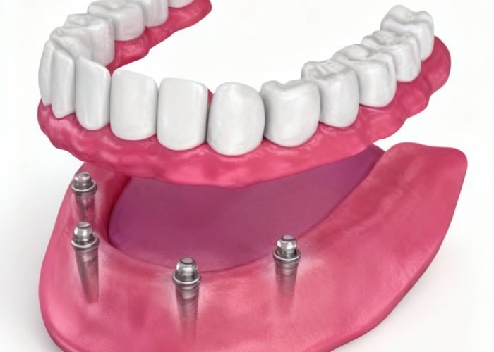 Implants-supported-dentures.jpeg